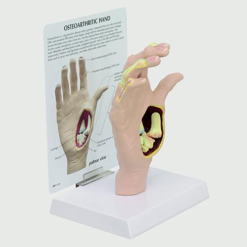 9251 1019520 01 Modell einer Hand mit Osteoarthritis