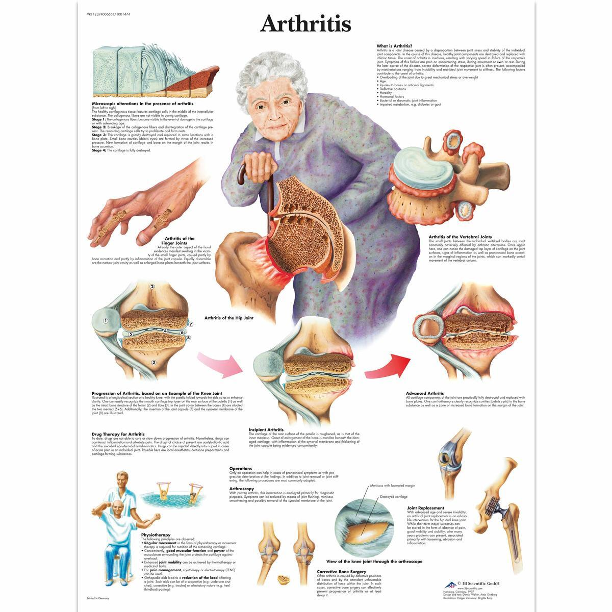 VR1123 L 01 1200 12001001474 Arthritis Chart 1