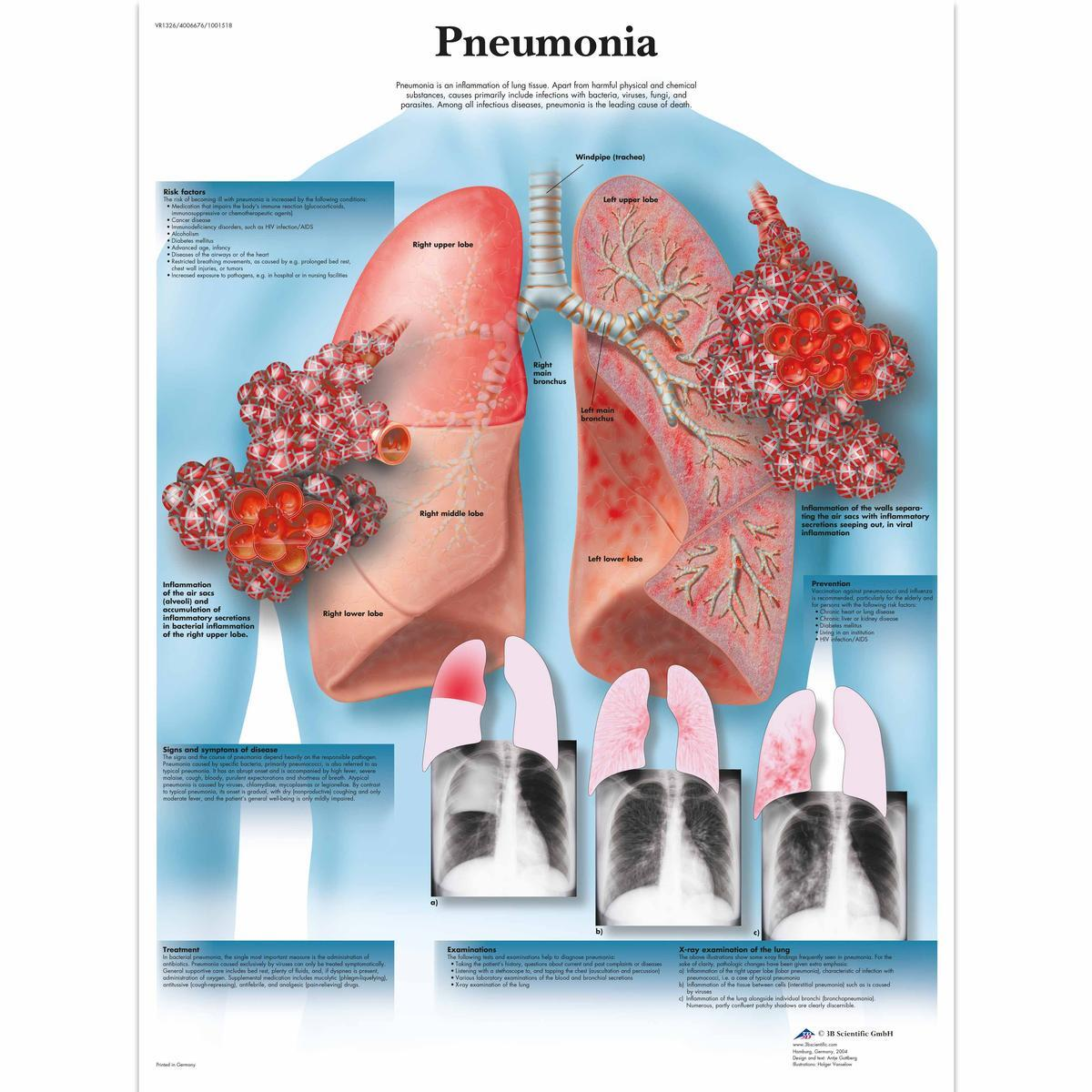 VR1326 L 01 1200 12001001518 Pneumonia Chart