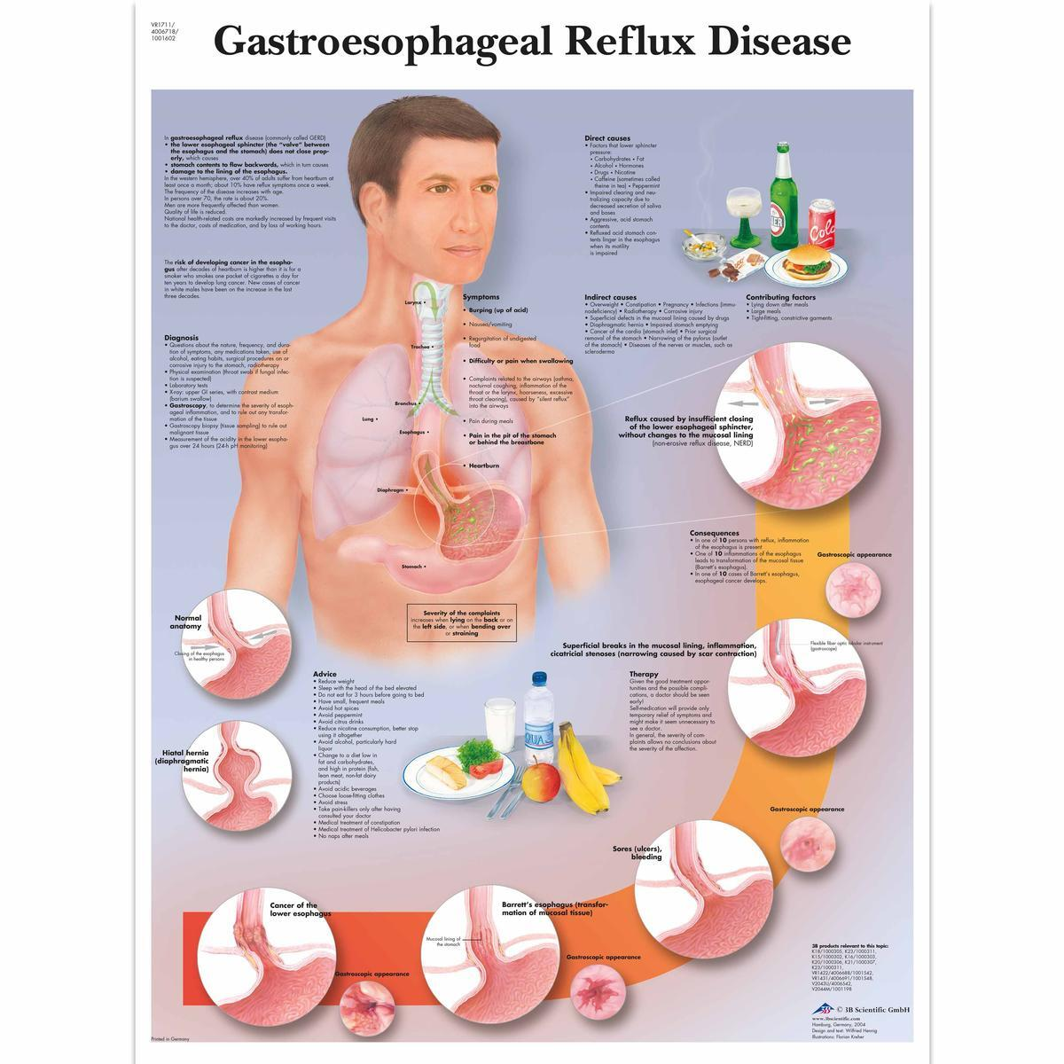 VR1711 UU 01 1200 12004006718 Gastroesophageal Ref