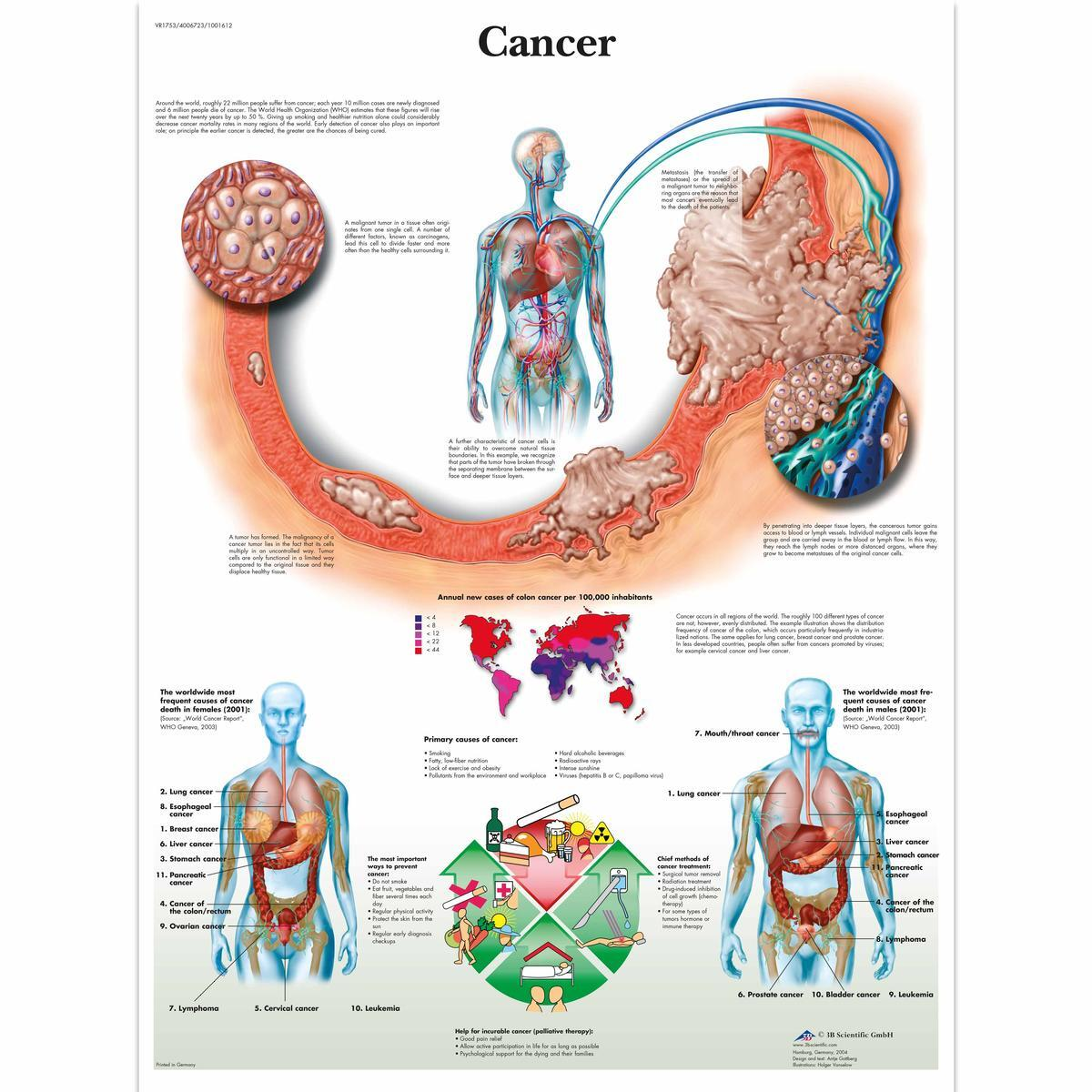 VR1753 UU 01 1200 12004006723 Cancer Chart