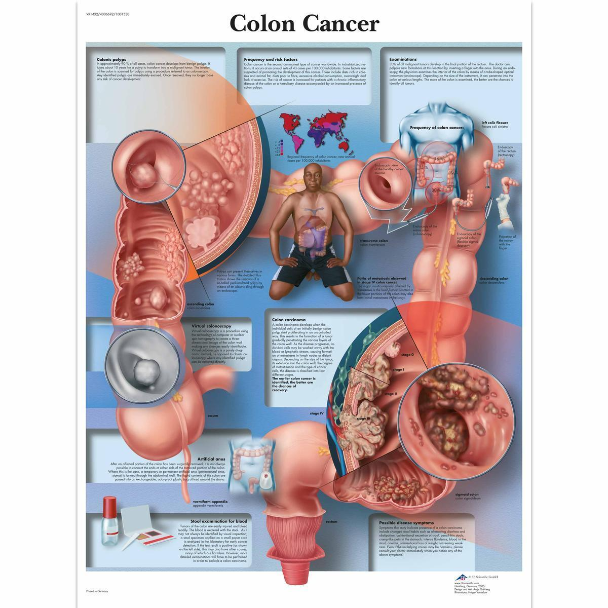 VR1432 L 01 1200 12001001550 Colon Cancer Chart