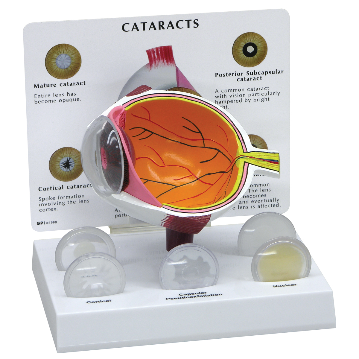 W47852 01 1200 12001019536 Cataract Eye